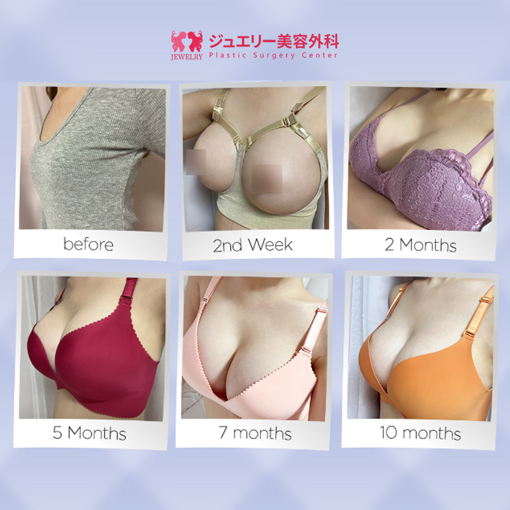 韓国輪郭 ｜ 韓国美容外科ジュエリー美容外科の目、鼻、顔、豊胸整形で