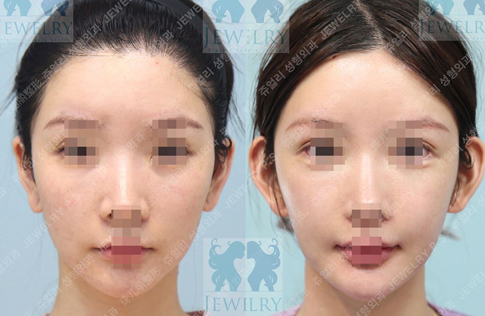 ジュエリー美容外科による**エルフ耳（立ち耳）**形成のビフォーアフター比較写真。左側のビフォー写真では正面から耳がほとんど見えず中顔面が強調されていますが、右側のアフター写真では耳を外側に立たせることで顔の余白が埋まり、小顔で立体的な印象に改善されている様子が示されています。
