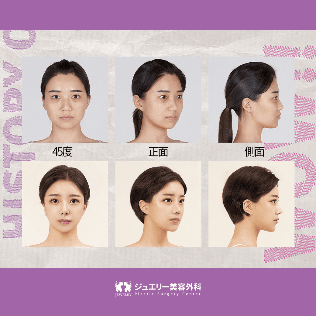 ジュエリー美容外科-顔面輪郭-脂肪移植-鼻整形-目整形-モデル (5) | ジュエリー美容外科 顔の正面、45度、側面前後の写真からわかる手術後記です。